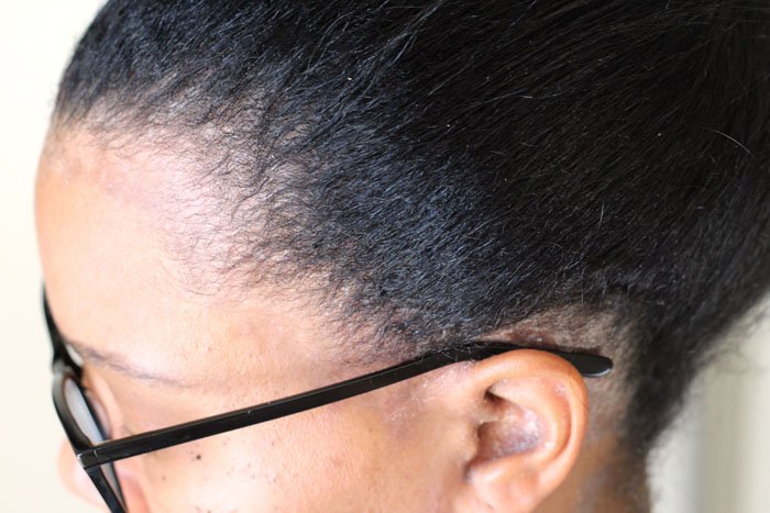 sideview of hair and scalp during psoriasis outbreak